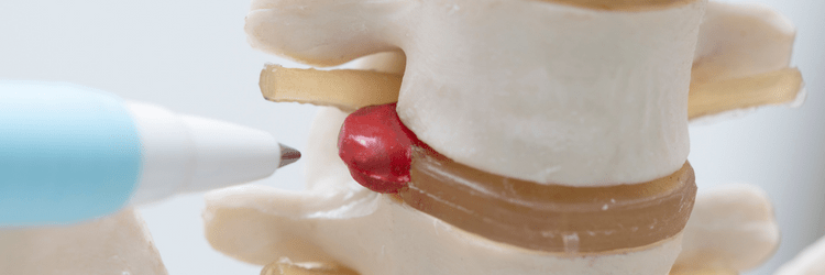 decompressie meest effectieve oplossing voor hernia onderrug