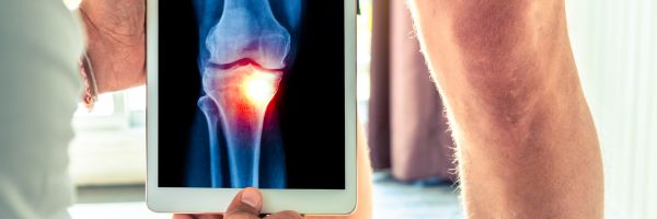 Foto van iemand met een rontgenfoto met artrose in de knie