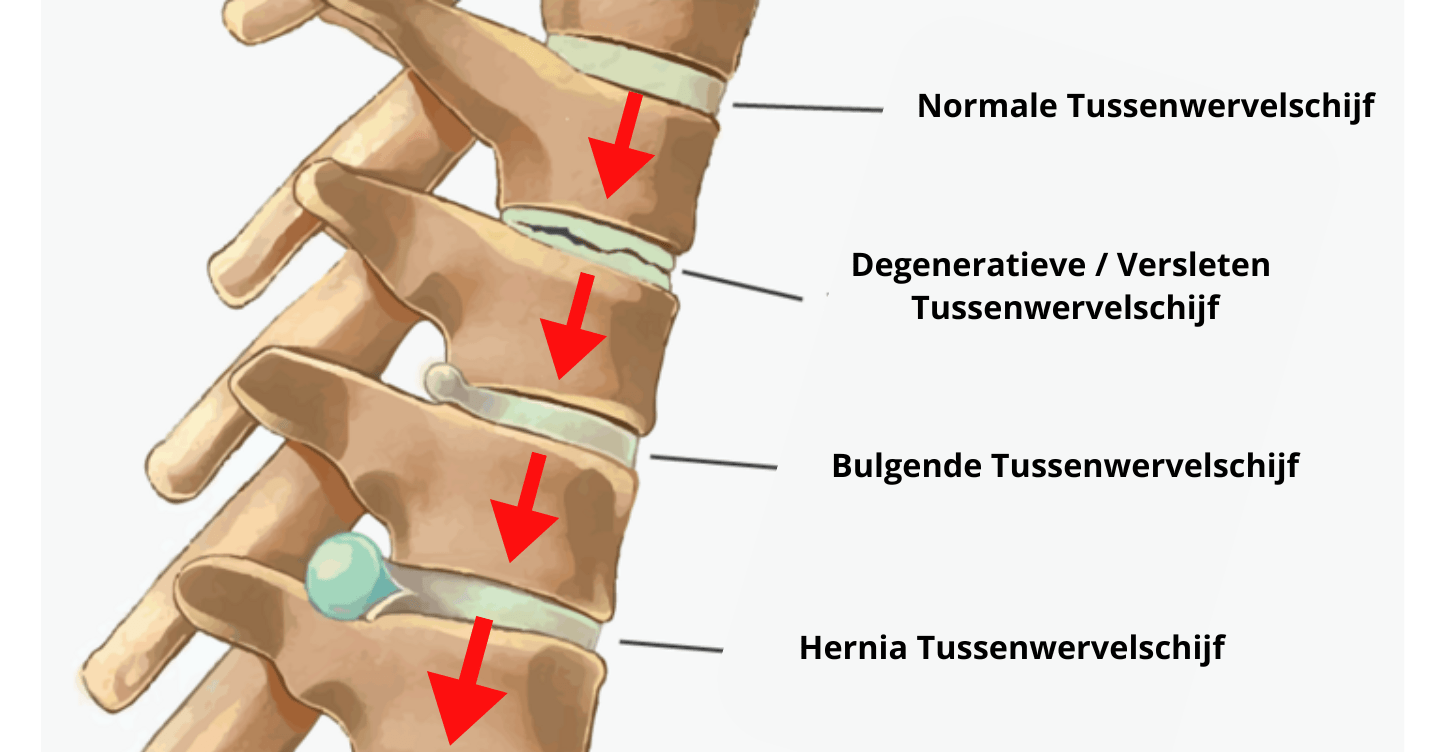 Hernia in de onderrug en decompressie 